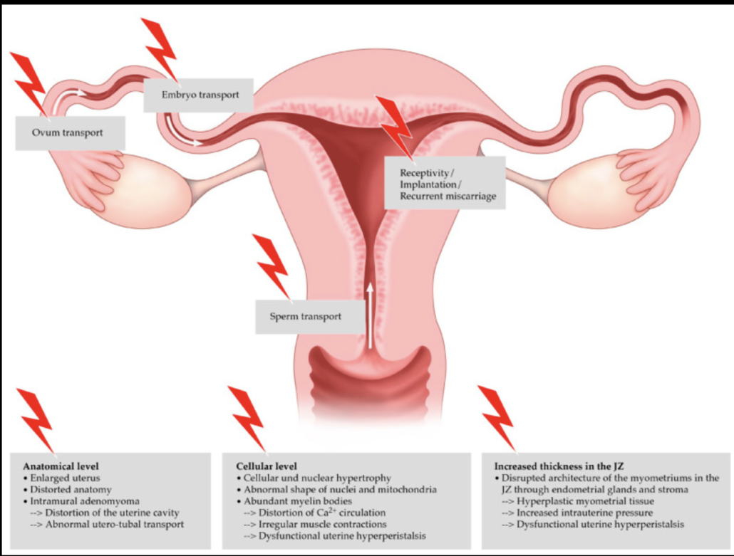 Diagram of adenomyosis in the reproductive organs